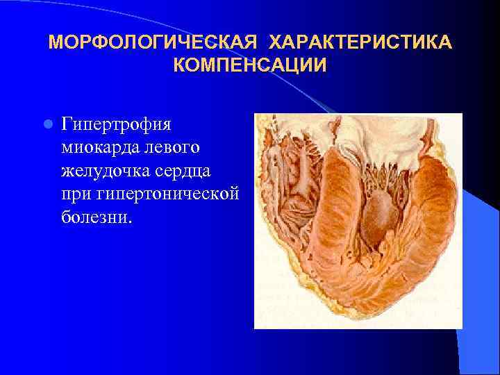 МОРФОЛОГИЧЕСКАЯ ХАРАКТЕРИСТИКА КОМПЕНСАЦИИ l Гипертрофия миокарда левого желудочка сердца при гипертонической болезни. 