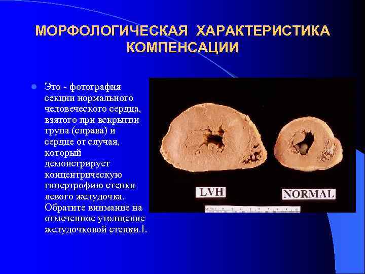 МОРФОЛОГИЧЕСКАЯ ХАРАКТЕРИСТИКА КОМПЕНСАЦИИ l Это - фотография секции нормального человеческого сердца, взятого при вскрытии