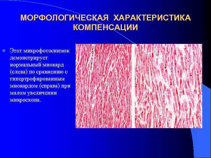 МОРФОЛОГИЧЕСКАЯ ХАРАКТЕРИСТИКА КОМПЕНСАЦИИ l Этот микрофотоснимок демонстрирует нормальный миокард (слева) по сравнению с гипертрофированным