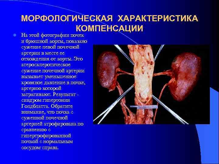 l МОРФОЛОГИЧЕСКАЯ ХАРАКТЕРИСТИКА КОМПЕНСАЦИИ На этой фотографии почек и брюшной аорты, показано сужение левой