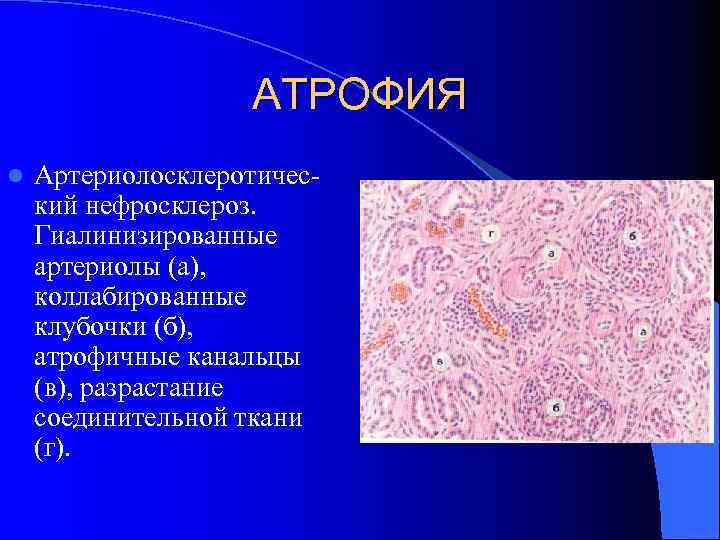 АТРОФИЯ l Артериолосклеротический нефросклероз. Гиалинизированные артериолы (а), коллабированные клубочки (б), атрофичные канальцы (в), разрастание