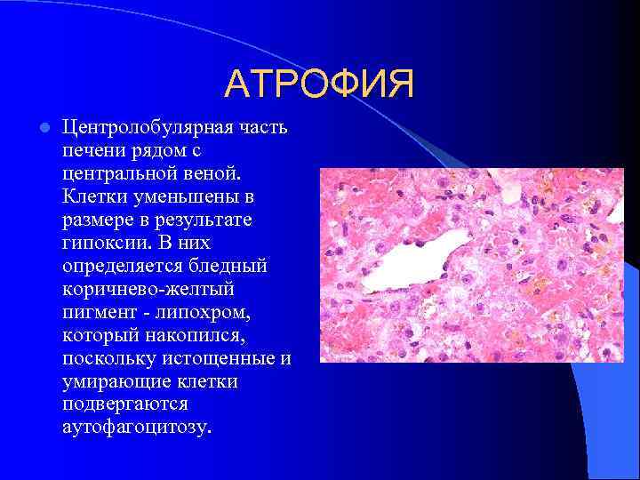 АТРОФИЯ l Центролобулярная часть печени рядом с центральной веной. Клетки уменьшены в размере в