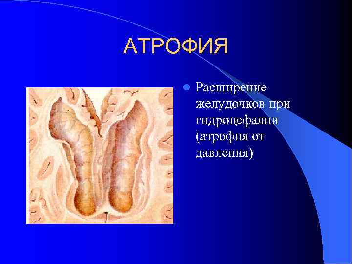 АТРОФИЯ l Расширение желудочков при гидроцефалии (атрофия от давления) 