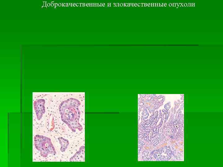 Доброкачественные и злокачественные опухоли 