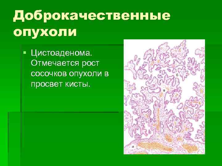 Доброкачественные опухоли § Цистоаденома. Отмечается рост сосочков опухоли в просвет кисты. 