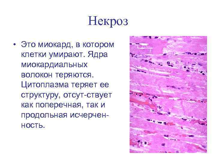 Некроз • Это миокард, в котором клетки умирают. Ядра миокардиальных волокон теряются. Цитоплазма теряет