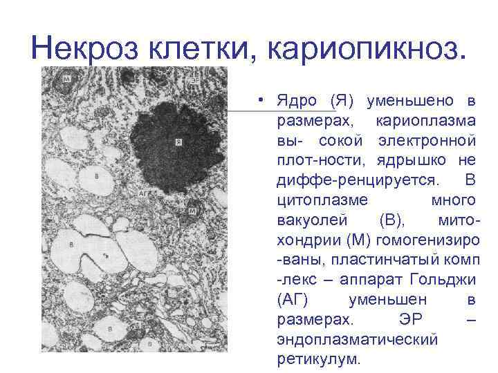 Некроз клетки, кариопикноз. • Ядро (Я) уменьшено в размерах, кариоплазма вы- сокой электронной плот-ности,