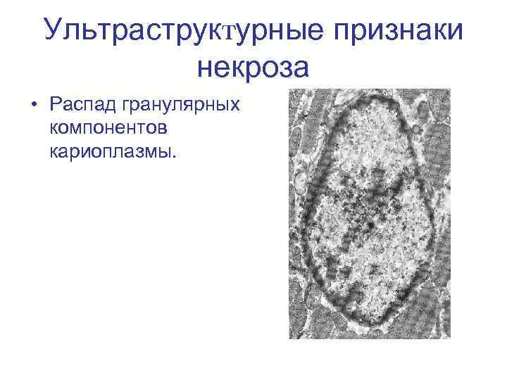 Ультраструктурные признаки некроза • Распад гранулярных компонентов кариоплазмы. 