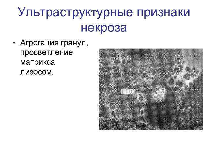 Ультраструктурные признаки некроза • Агрегация гранул, просветление матрикса лизосом. 