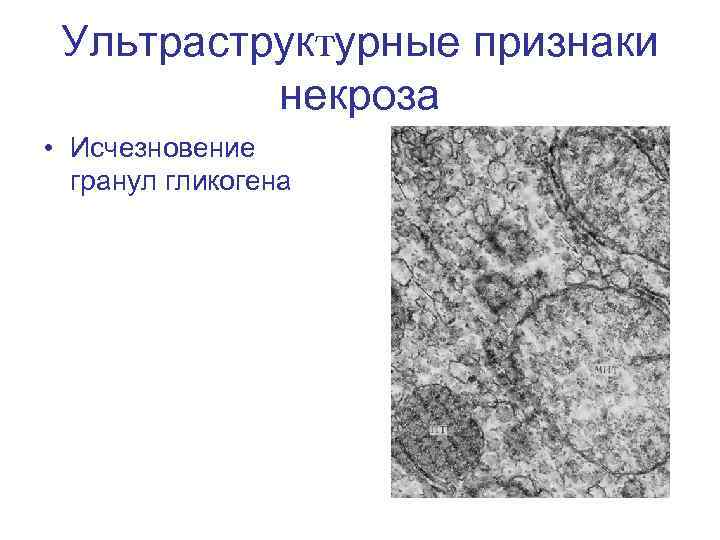 Ультраструктурные признаки некроза • Исчезновение гранул гликогена 