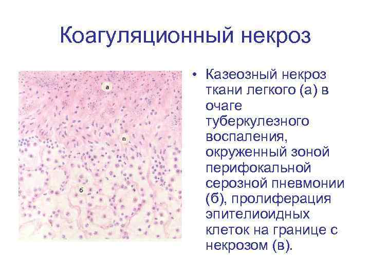 Коагуляционный некроз • Казеозный некроз ткани легкого (а) в очаге туберкулезного воспаления, окруженный зоной