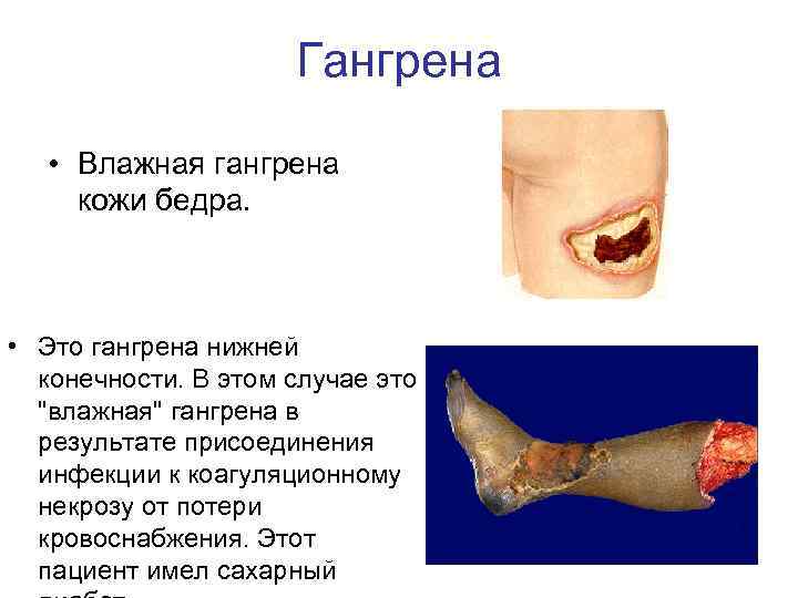 Гангрена • Влажная гангрена кожи бедра. • Это гангрена нижней конечности. В этом случае