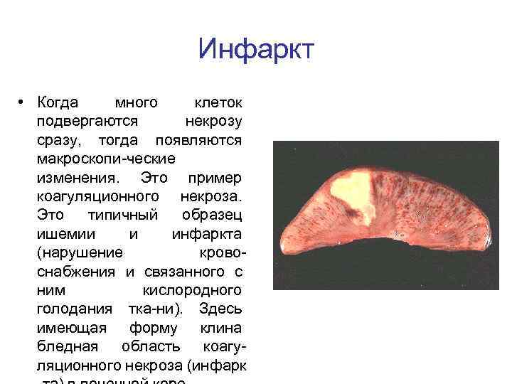 Инфаркт • Когда много клеток подвергаются некрозу сразу, тогда появляются макроскопи-ческие изменения. Это пример