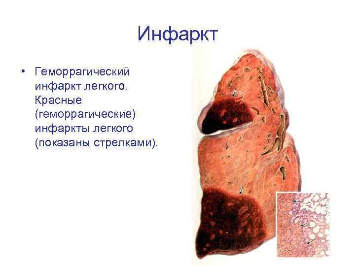 Инфаркт • Геморрагический инфаркт легкого. Красные (геморрагические) инфаркты легкого (показаны стрелками). 