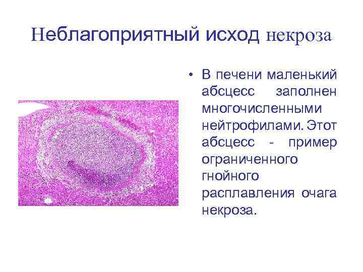 Неблагоприятный исход некроза • В печени маленький абсцесс заполнен многочисленными нейтрофилами. Этот абсцесс -