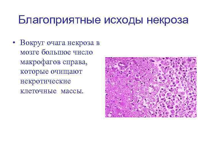 Благоприятные исходы некроза • Вокруг очага некроза в мозге большое число макрофагов справа, которые