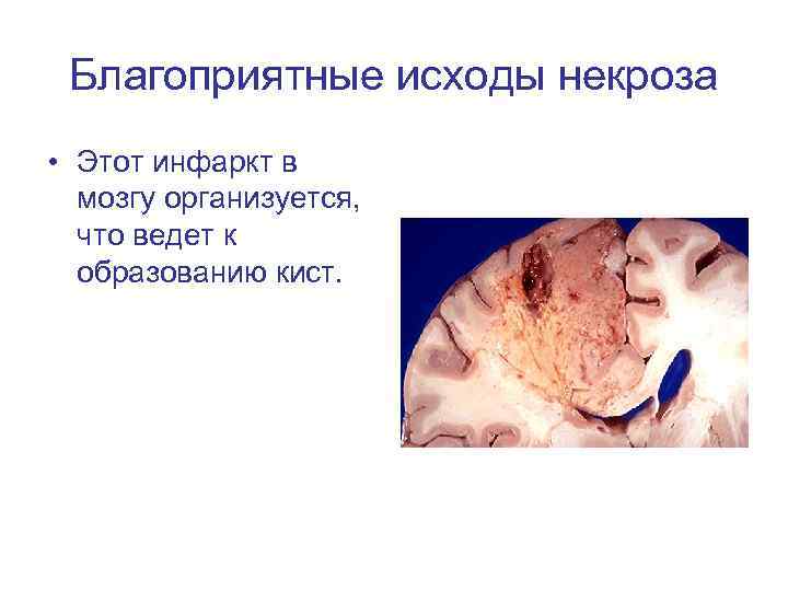 Благоприятные исходы некроза • Этот инфаркт в мозгу организуется, что ведет к образованию кист.