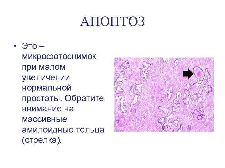 АПОПТОЗ • Это – микрофотоснимок при малом увеличении нормальной простаты. Обратите внимание на массивные