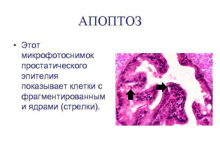 АПОПТОЗ • Этот микрофотоснимок простатического эпителия показывает клетки c фрагментированным и ядрами (стрелки). 