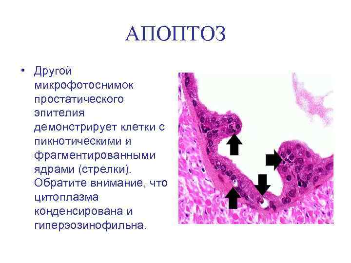 АПОПТОЗ • Другой микрофотоснимок простатического эпителия демонстрирует клетки с пикнотическими и фрагментированными ядрами (стрелки).