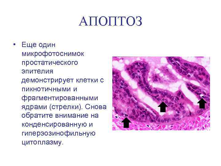 АПОПТОЗ • Еще один микрофотоснимок простатического эпителия демонстрирует клетки с пикнотичными и фрагментированными ядрами