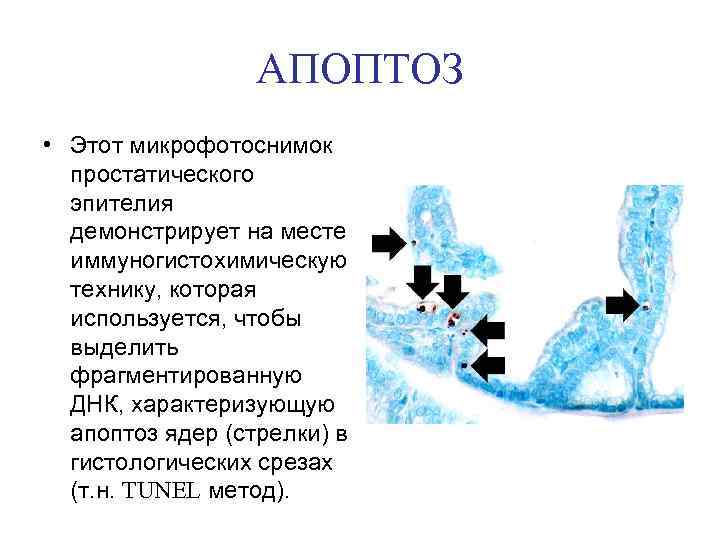 АПОПТОЗ • Этот микрофотоснимок простатического эпителия демонстрирует на месте иммуногистохимическую технику, которая используется, чтобы