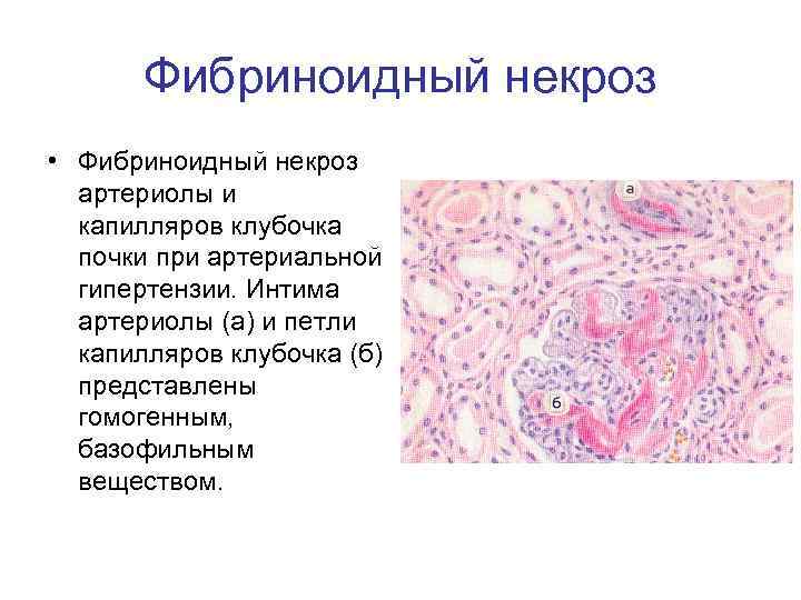 Фибриноидный некроз • Фибриноидный некроз артериолы и капилляров клубочка почки при артериальной гипертензии. Интима