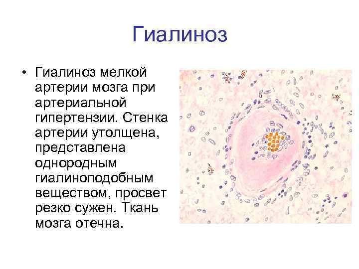 Гиалиноз • Гиалиноз мелкой артерии мозга при артериальной гипертензии. Стенка артерии утолщена, представлена однородным