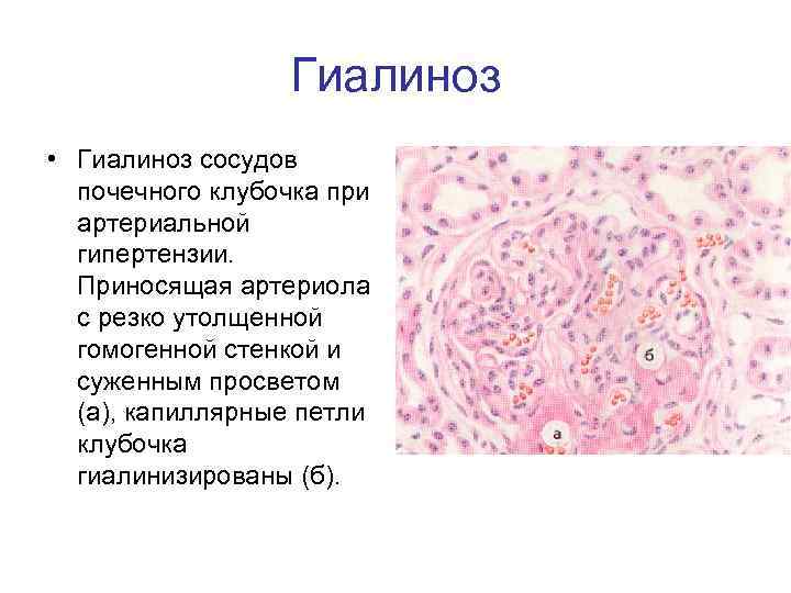 Гиалиноз • Гиалиноз сосудов почечного клубочка при артериальной гипертензии. Приносящая артериола с резко утолщенной