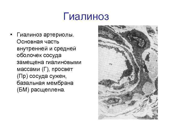 Гиалиноз • Гиалиноз артериолы. Основная часть внутренней и средней оболочек сосуда замещена гиалиновыми массами