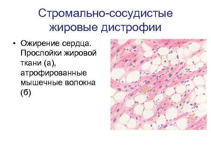 Стромально-сосудистые жировые дистрофии • Ожирение сердца. Прослойки жировой ткани (а), атрофированные мышечные волокна (б)