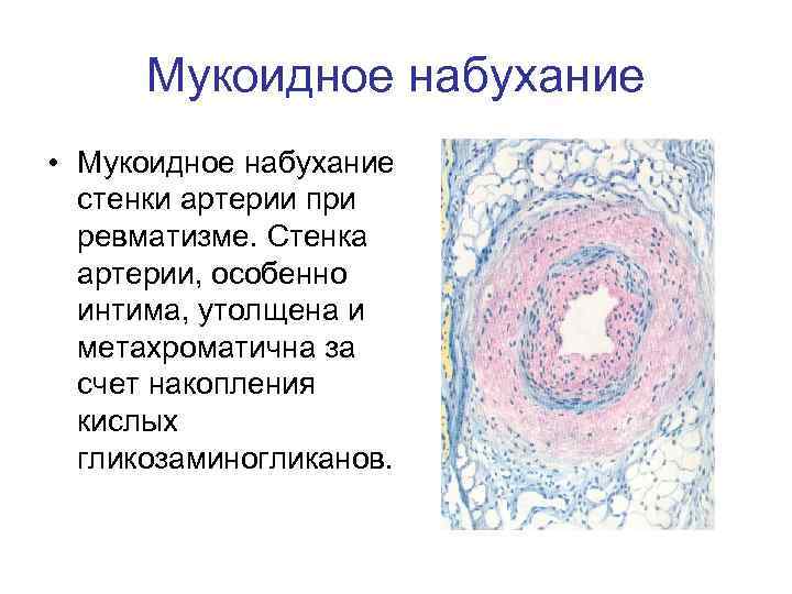 Мукоидное набухание • Мукоидное набухание стенки артерии при ревматизме. Стенка артерии, особенно интима, утолщена