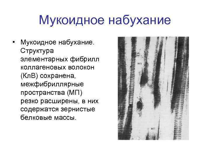 Мукоидное набухание • Мукоидное набухание. Структура элементарных фибрилл коллагеновых волокон (Кл. В) сохранена, межфибриллярные