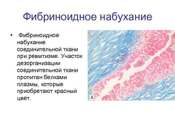 Фибриноидное набухание • Фибриноидное набухание соединительной ткани при ревмтизме. Участок дезорганизации соединительной ткани пропитан