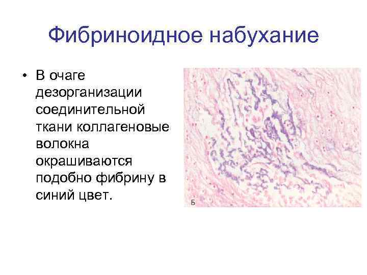 Фибриноидное набухание • В очаге дезорганизации соединительной ткани коллагеновые волокна окрашиваются подобно фибрину в