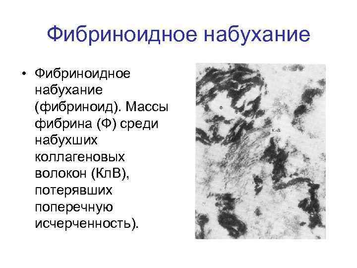 Фибриноидное набухание • Фибриноидное набухание (фибриноид). Массы фибрина (Ф) среди набухших коллагеновых волокон (Кл.