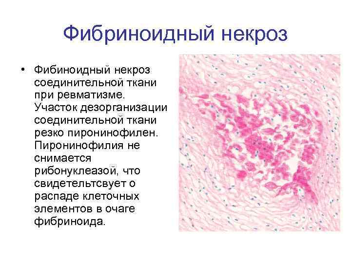 Фибриноидный некроз • Фибиноидный некроз соединительной ткани при ревматизме. Участок дезорганизации соединительной ткани резко