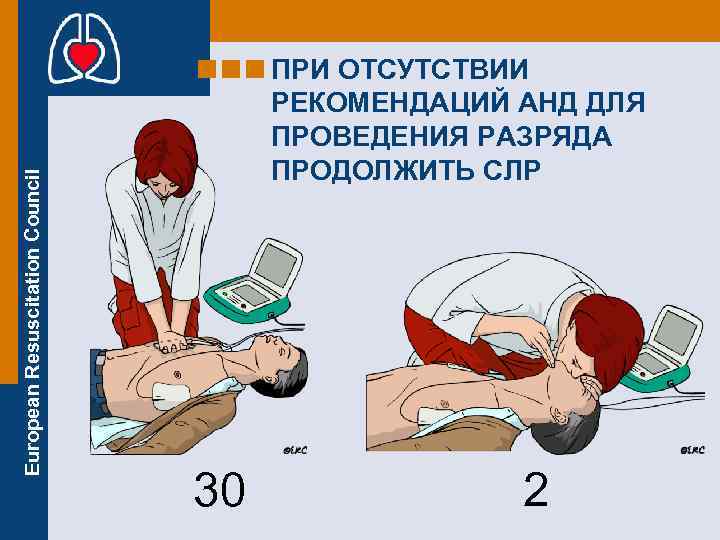 European Resuscitation Council ПРИ ОТСУТСТВИИ РЕКОМЕНДАЦИЙ АНД ДЛЯ ПРОВЕДЕНИЯ РАЗРЯДА ПРОДОЛЖИТЬ СЛР 30 2