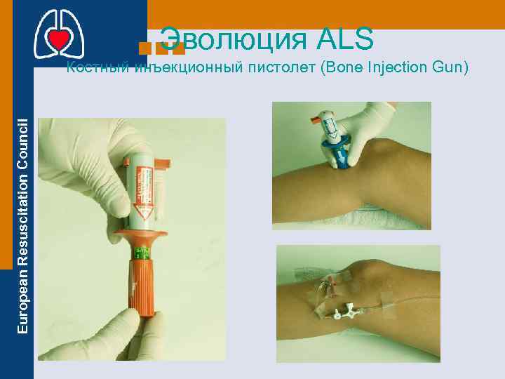 Эволюция ALS European Resuscitation Council Костный инъекционный пистолет (Bone Injection Gun) 