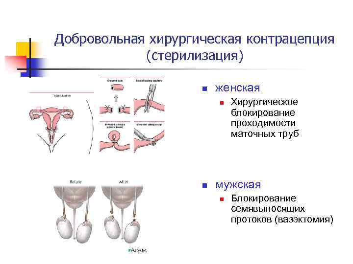 Добровольная хирургическая контрацепция (стерилизация) n женская n n Хирургическое блокирование проходимости маточных труб мужская