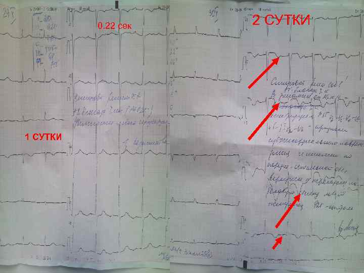 0. 22 сек 1 СУТКИ 2 СУТКИ 