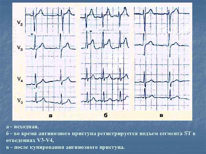 Подъем st. Подъем St в v3 v4. ЭКГ: подъем сегмента St в отведениях v2-v3-v. Подъем сегмента St в отведениях v3-v6. Элевация сегмента St в отведениях v4, v5.