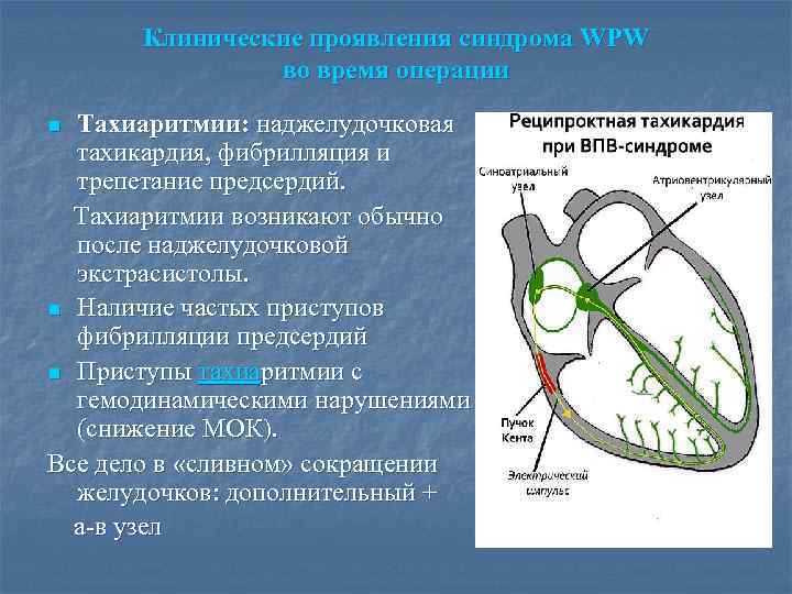 Клинические проявления синдрома WPW во время операции Тахиаритмии: наджелудочковая тахикардия, фибрилляция и трепетание предсердий.