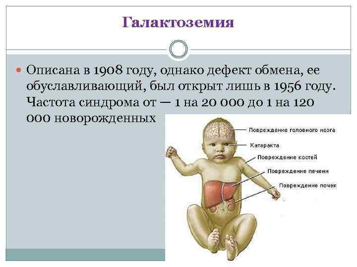 Галактоземия Описана в 1908 году, однако дефект обмена, ее обуславливающий, был открыт лишь в