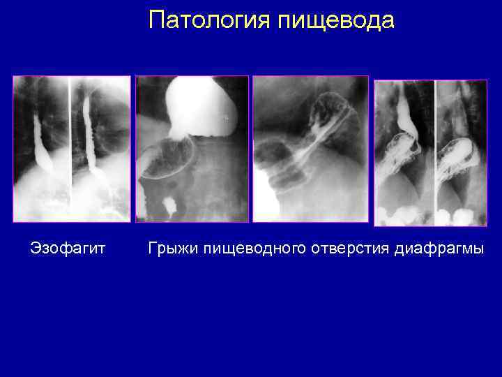 Патология пищевода Эзофагит Грыжи пищеводного отверстия диафрагмы 