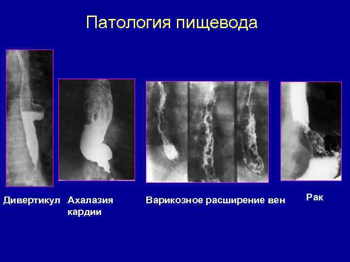 Патология пищевода Дивертикул Ахалазия кардии Варикозное расширение вен Рак 