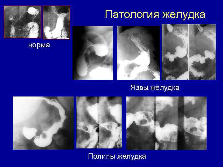 Патология желудка норма Язвы желудка Полипы желудка 
