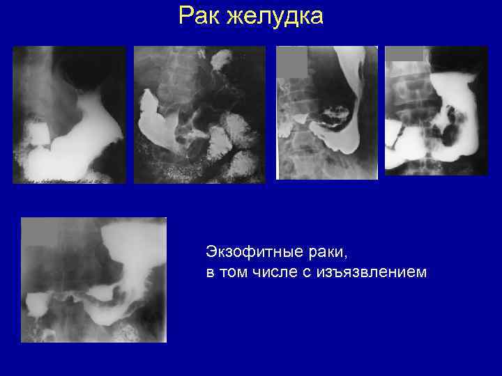 Рак желудка Экзофитные раки, в том числе с изъязвлением 