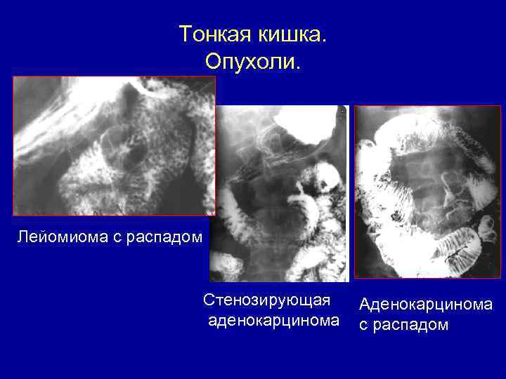 Тонкая кишка. Опухоли. Лейомиома с распадом Стенозирующая аденокарцинома Аденокарцинома с распадом 