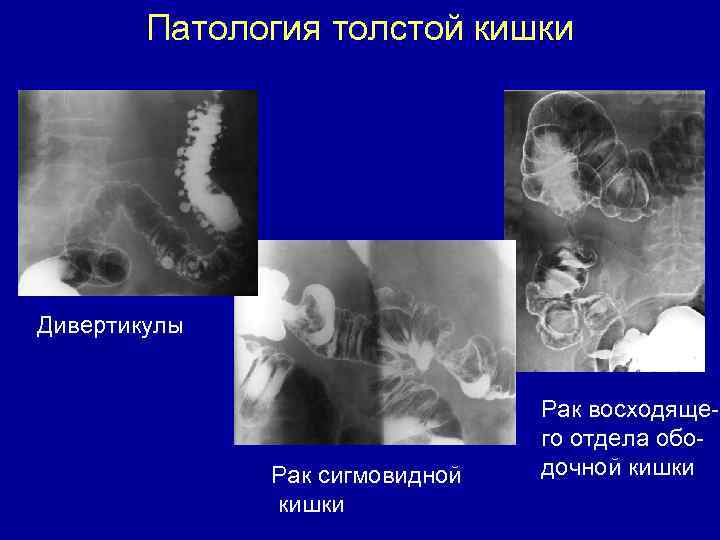 Патология толстой кишки Дивертикулы Рак сигмовидной кишки Рак восходящего отдела ободочной кишки 